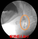 嚥下造影検査（ VF：Videofluoroscopic examination ）