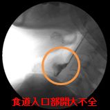 嚥下機能検査の意義